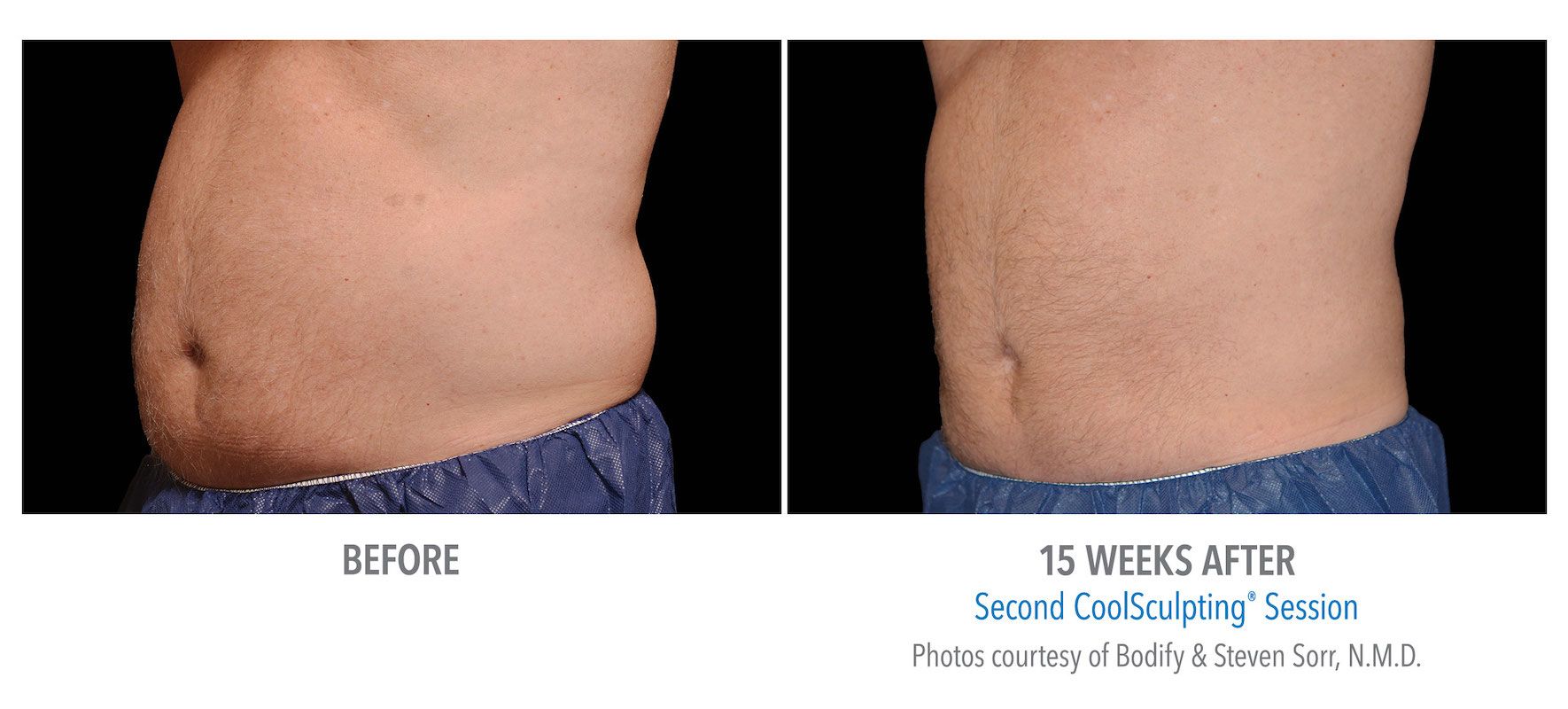 Male CoolSculpting patient in Las Vegas. Before and after photo of abdomen and flanks.