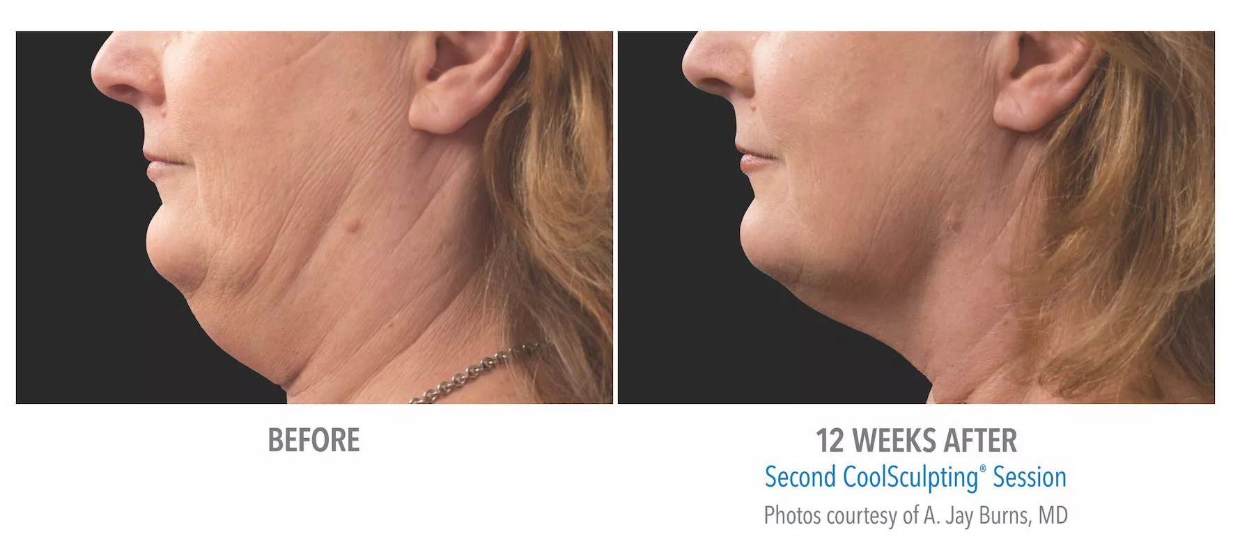 Female CoolSculpting patient in Summerlin. Before and after photo of chin / jawline 12 weeks post CoolSculpting treatment. Patient did not use Kybella.