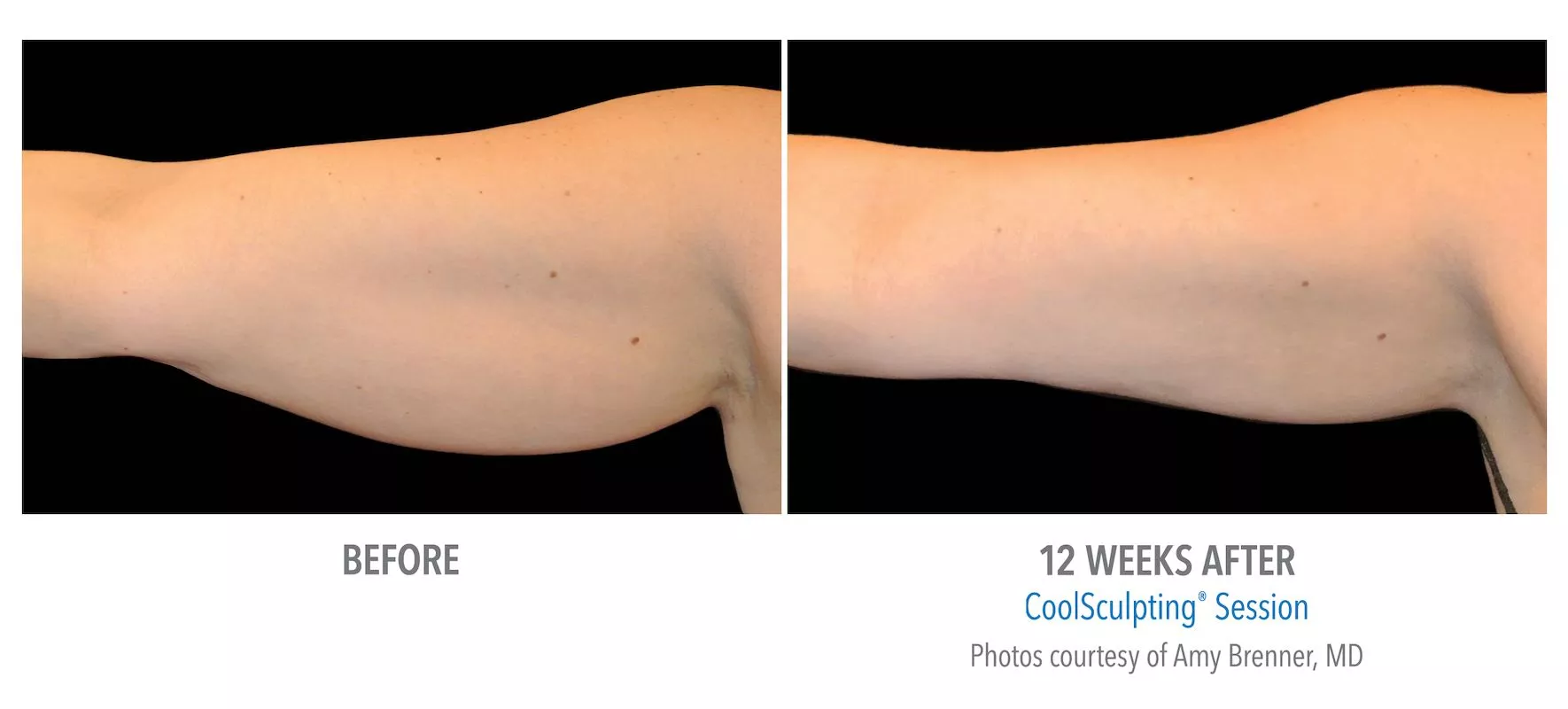 Female CoolSculpting patient in Las Vegas. Before and after photo of arms post CoolSculpting treatment.