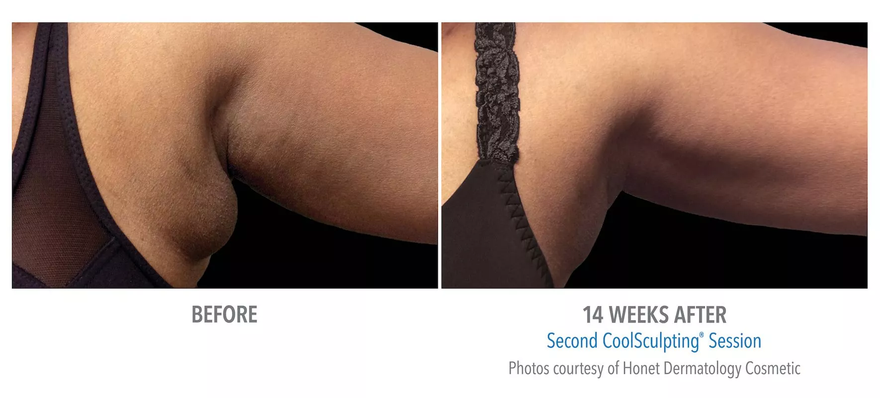 Female CoolSculpting patient in Las Vegas. Before and after photo of arms post CoolSculpting treatment.