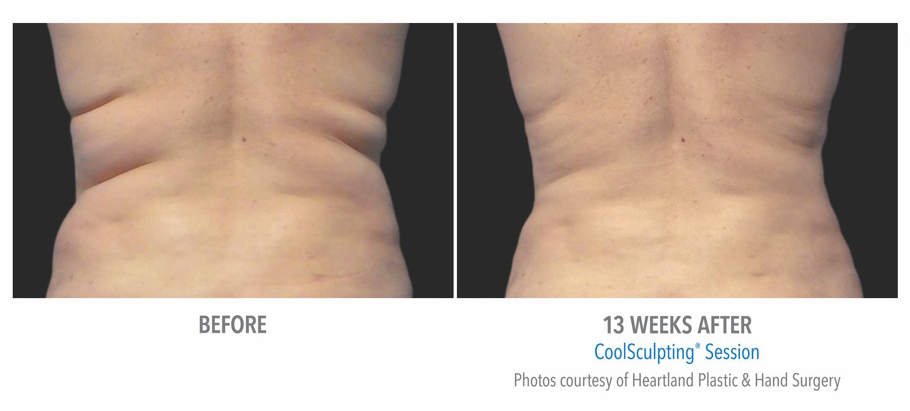 Female CoolSculpting patient in Summerlin. Before and after photo of back and flanks.