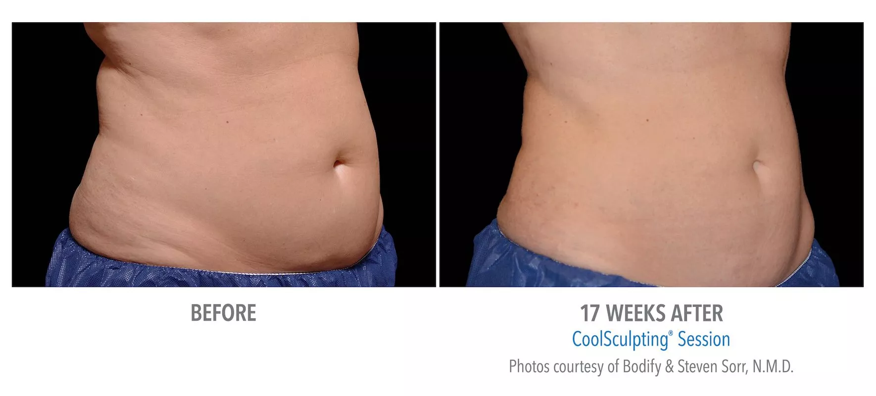 Female CoolSculpting patient in Las Vegas. Before and after photo of lower and upper abs 17 weeks post CoolSculpting treatment.