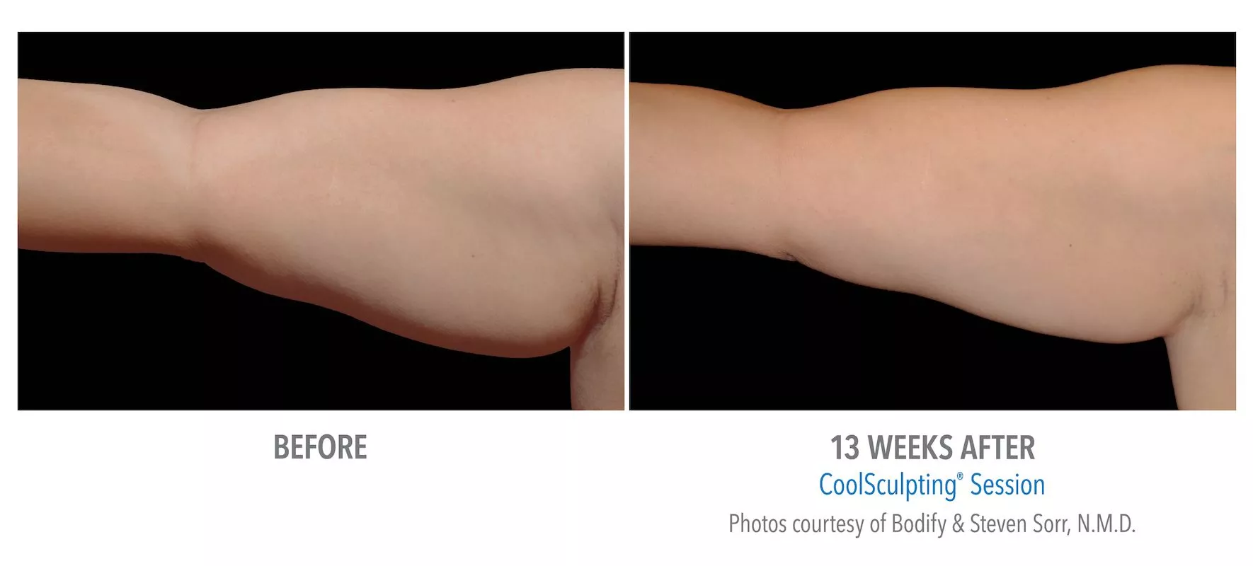 Female CoolSculpting patient in Las Vegas. Before and after photo of arms 13 weeks post CoolSculpting treatment.