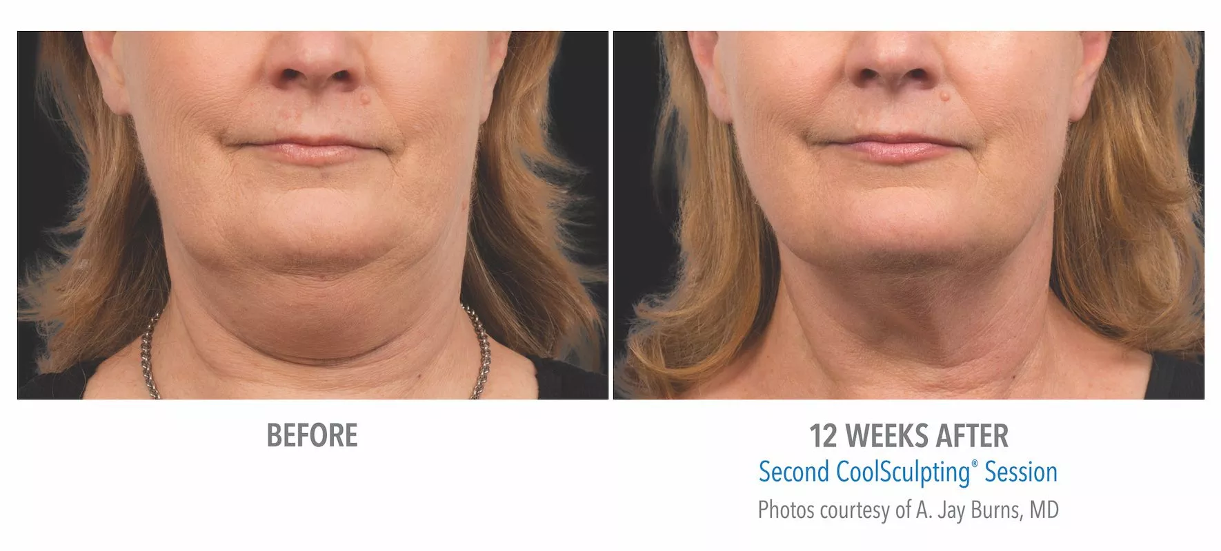 Female CoolSculpting patient in Summerlin. Before and after photo of chin / jawline 12 weeks post CoolSculpting treatment. Patient did not use Kybella.