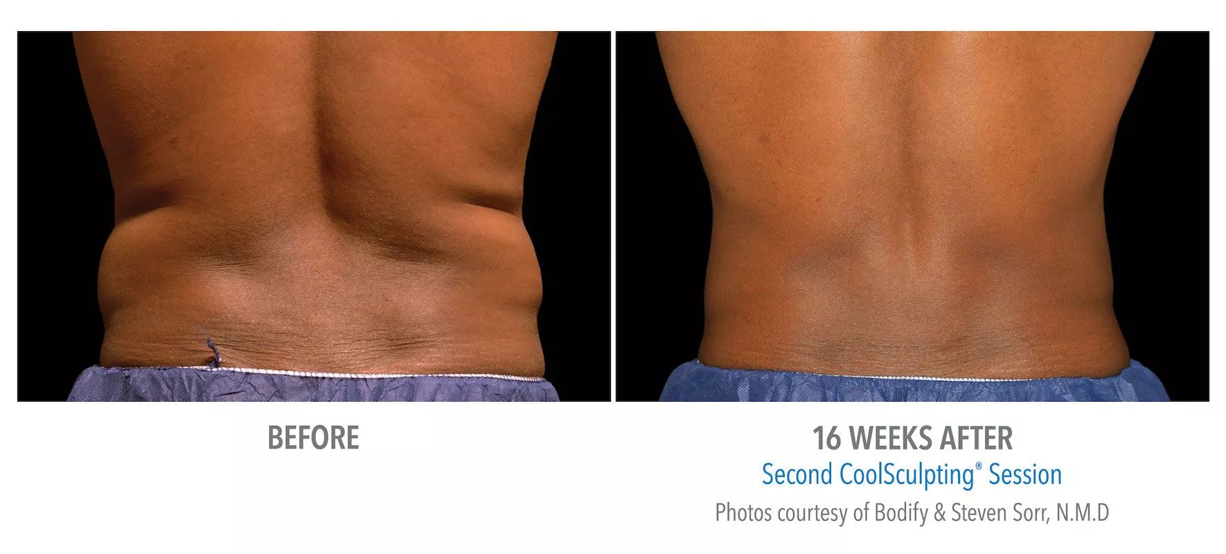 Male CoolSculpting patient in Las Vegas. Before and after photo of flanks 16 weeks post treatment.