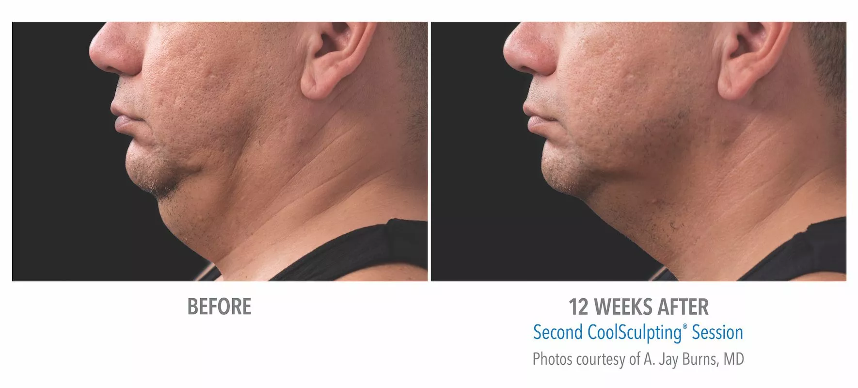 Male CoolSculpting patient in Las Vegas. Before and after photo of chin / jawline 12 weeks post CoolSculpting treatment. Patient did not use Kybella.