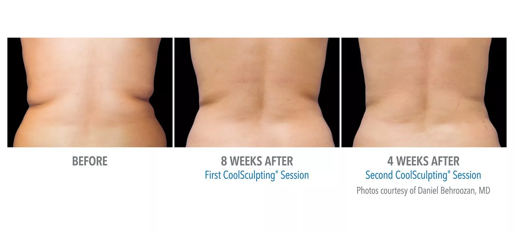 Female CoolSculpting patient in Las Vegas. Before and after photos of flanks post first and second CoolSculpting treatments.