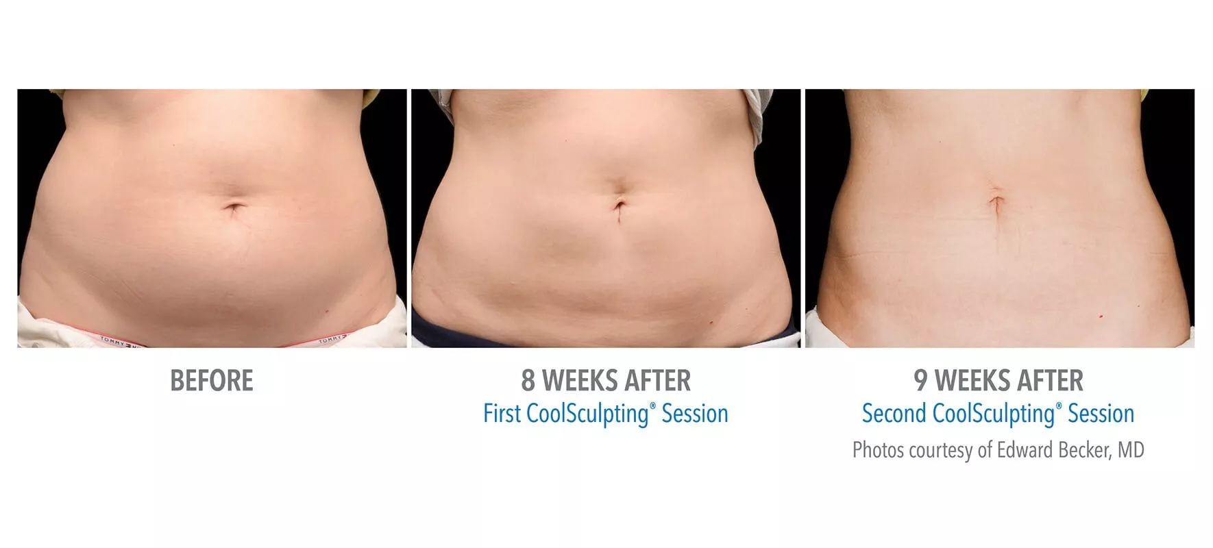 Female CoolSculpting patient in Las Vegas. Before and after photos of abs post first and second CoolSculpting treatments.