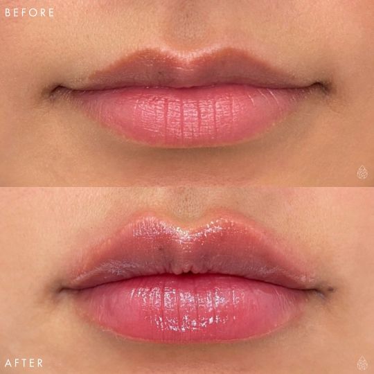 Las Vegas Lip filler before and after using Restylane Kysse at local Las Vegas body contouring medspa.