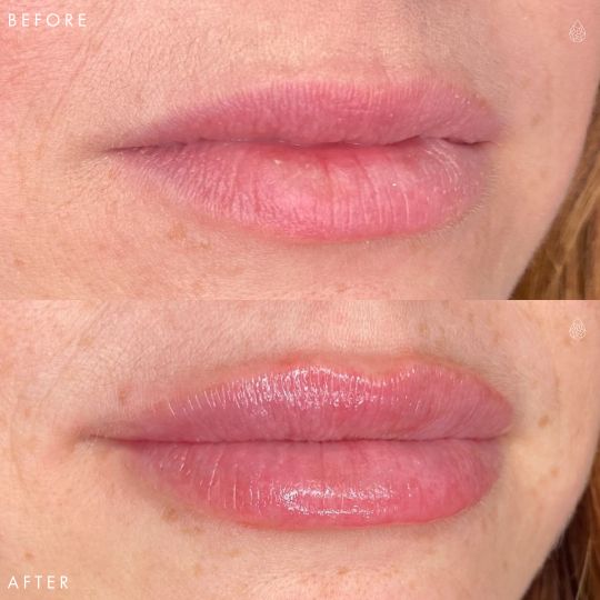 Las Vegas Lip filler before and after using Restylane Kysse at local Las Vegas body contouring medspa.