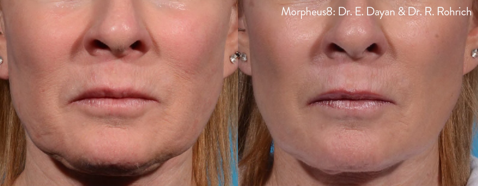 Morpheus 8 - Before and After front facing