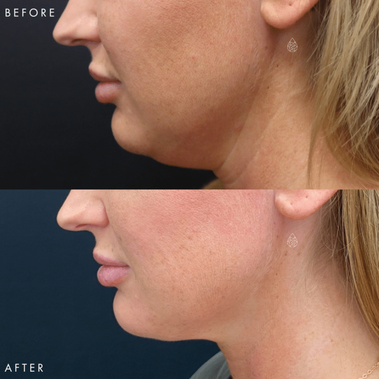 CoolSculpting Las Vegas - Chin Before & After 1