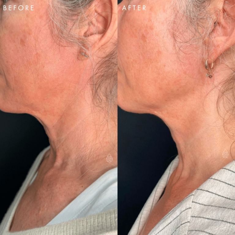 Las Vegas Lip filler before and after using Morpheus8 at local Las Vegas body contouring medspa.