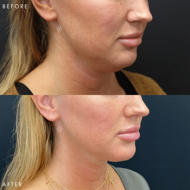 CoolSculpting Las Vegas - Chin Before & After 2