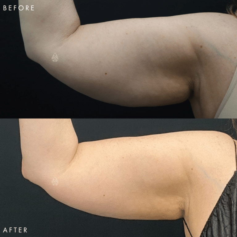 CoolSculpting Las Vegas - Arms Before & After 2