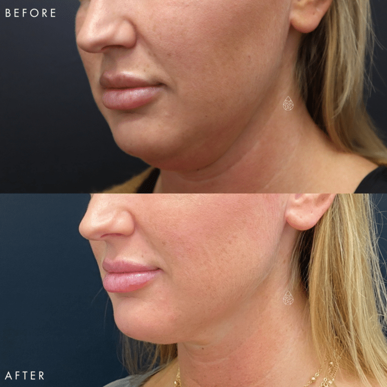 CoolSculpting Las Vegas - Chin Before & After 3