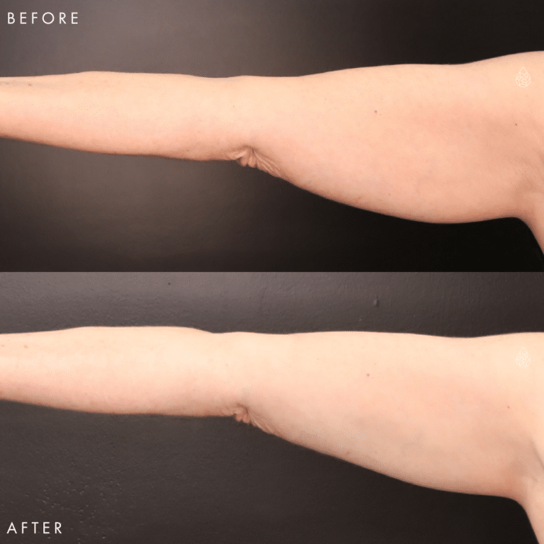 CoolSculpting Las Vegas - Arms Before & After 3