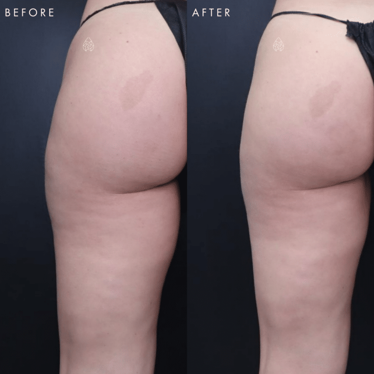 CoolSculpting Las Vegas - Thighs Before & After 3