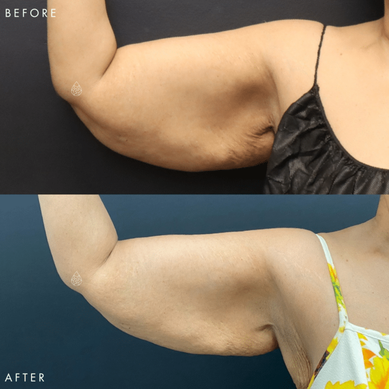 CoolSculpting Las Vegas - Arms Before & After 4