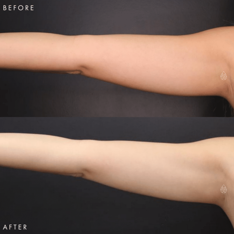 CoolSculpting Las Vegas - Arms Before & After 5