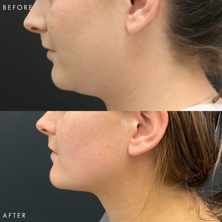 CoolSculpting Las Vegas - Chin Before & After 6