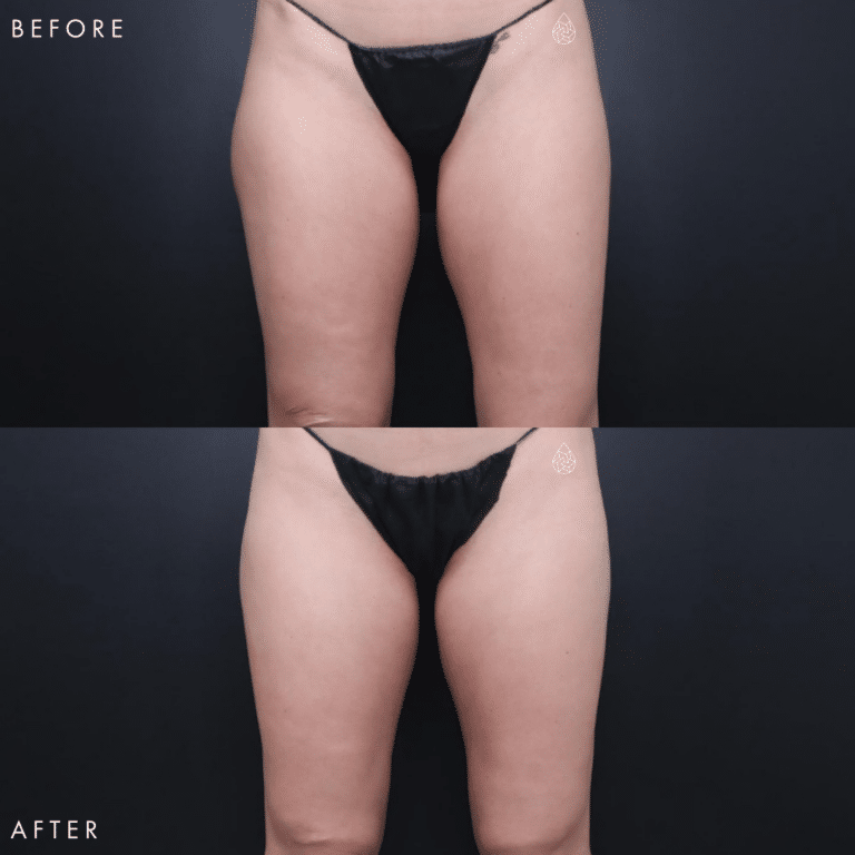 CoolSculpting Las Vegas - Thighs Before & After 5