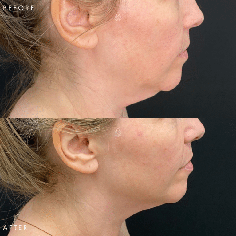 Las Vegas Lip filler before and after using Morpheus8 at local Las Vegas body contouring medspa.