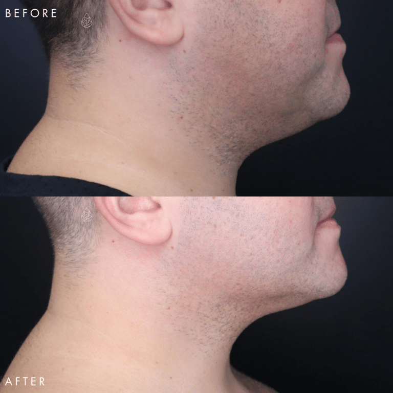 CoolSculpting Las Vegas - Chin Before & After 7