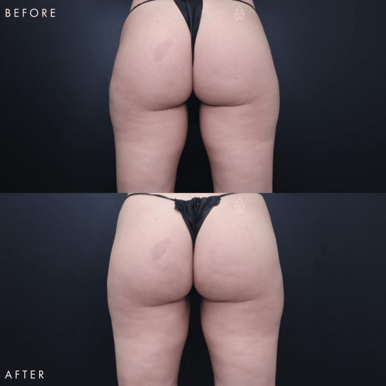 CoolSculpting Las Vegas - Thighs Before & After 6