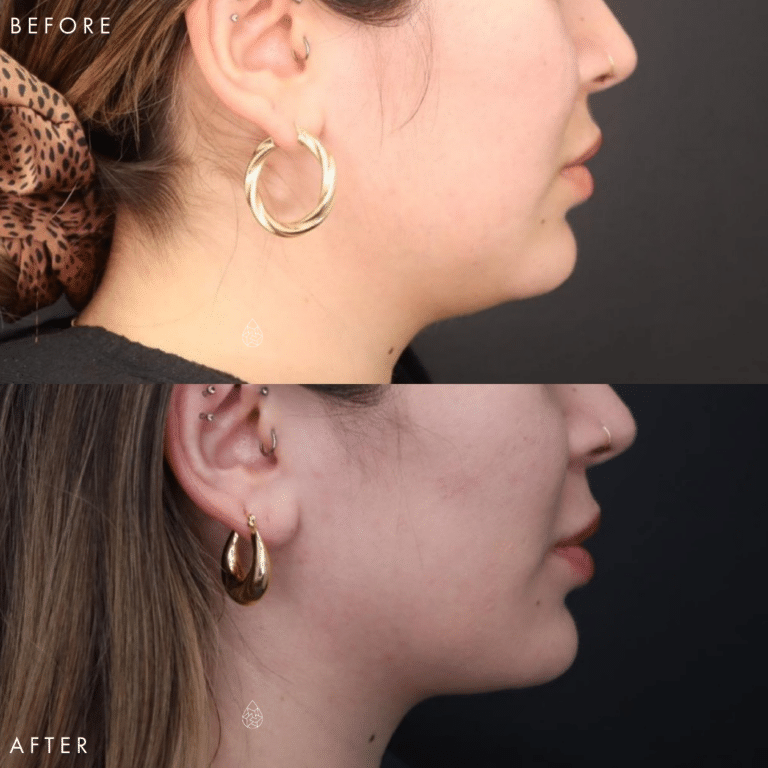 CoolSculpting Las Vegas - Chin Before & After 8
