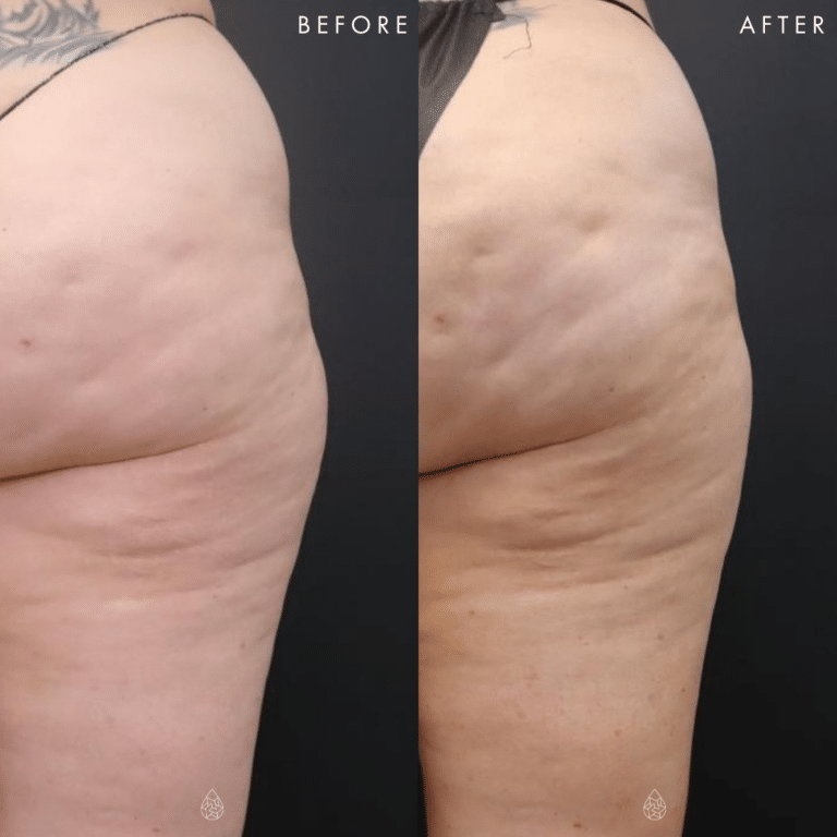 CoolSculpting Las Vegas - Thighs Before & After 7