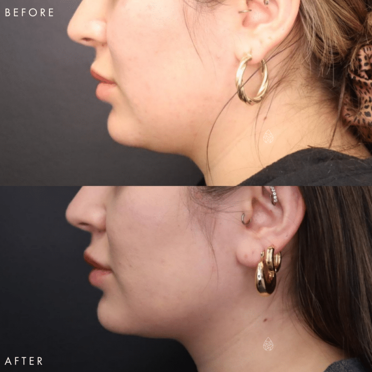 CoolSculpting Las Vegas - Chin Before & After 9