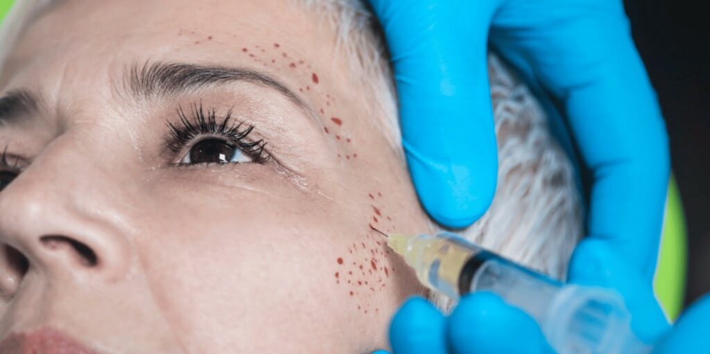 PRP Microneedling: The Ultimate Guide to PRP Microneedling