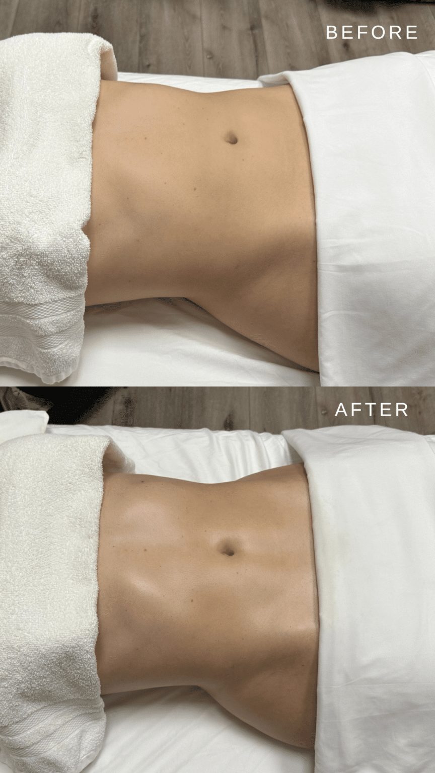 Before & After - Lymphatic Drainage