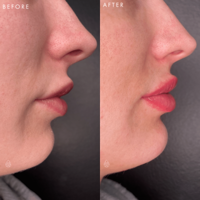 Facial Fillers - Before & Afters